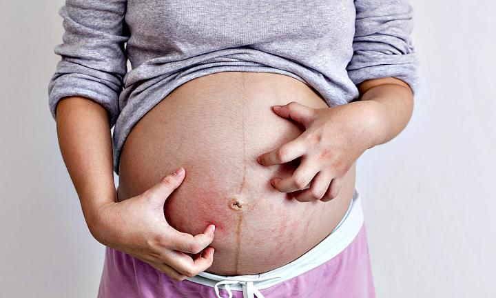 pregnant-woman-scratching-her-belly-20170224150742.jpg~q75,dx720y432u1r1gg,c--